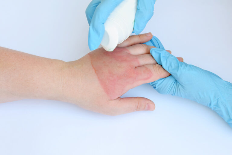 How To Get Rid of Heating Pad Burns Med Consumers